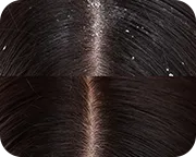 Dandruff